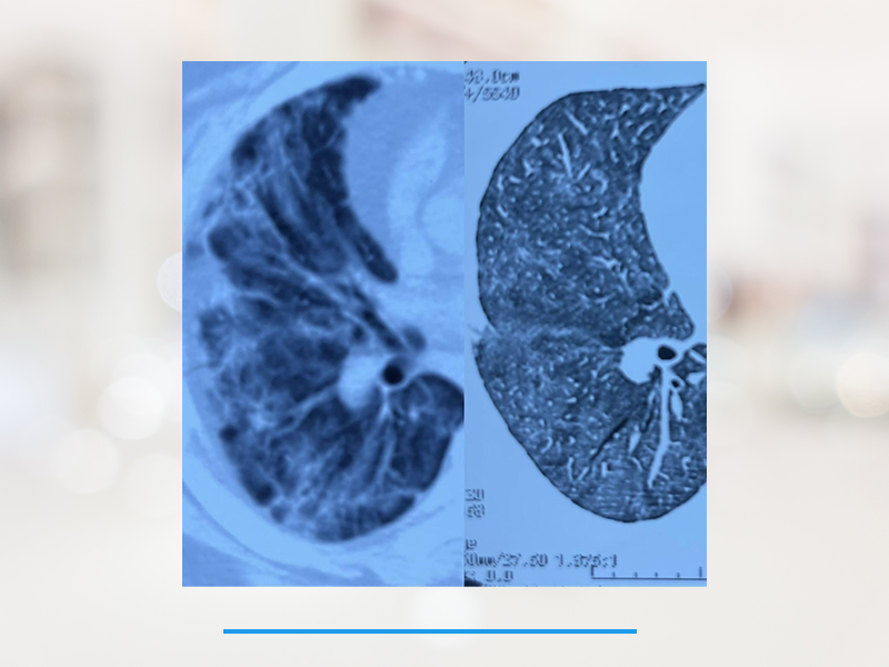 Rehabilitación Pulmonar post COVID 19